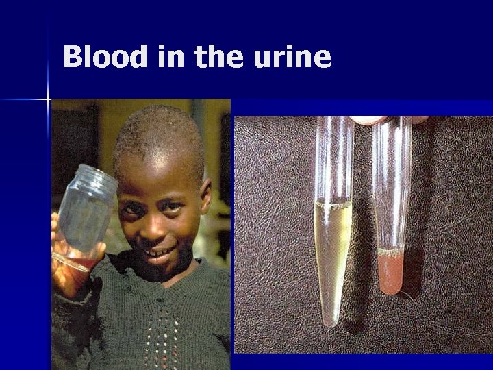 Blood in the urine 