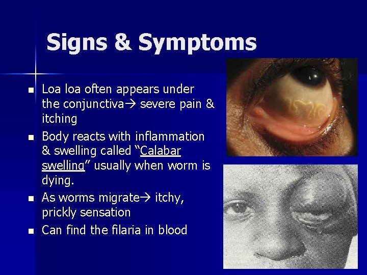 Signs & Symptoms n n Loa loa often appears under the conjunctiva severe pain