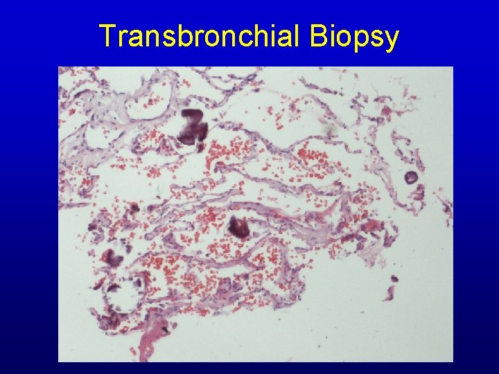 Transbronchial Biopsy Transbronchial Biopsy