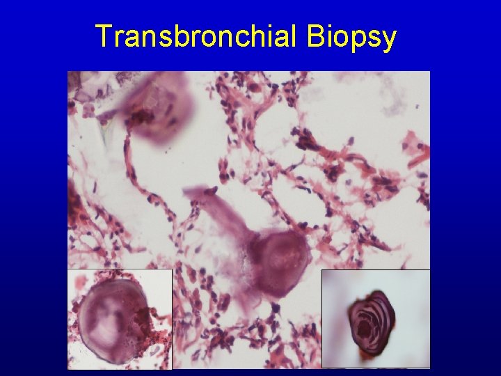 Transbronchial Biopsy Transbronchial Biopsy