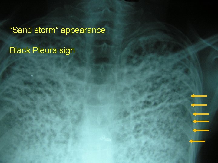 Chest X-ray/ CT “Sand storm” appearance Black Pleura sign Chest X-ray/ CT “Sand storm” appearance Black Pleura sign