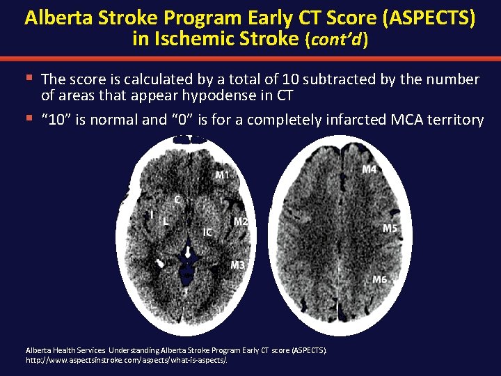 Alberta Stroke Program Early CT Score (ASPECTS) in Ischemic Stroke (cont’d ) § The