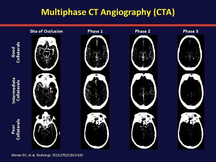 Multiphase CT Angiography (CTA) Poor Collaterals Intermediate Collaterals Good Collaterals Site of Occlusion Menon