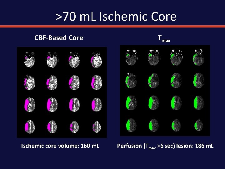 >70 m. L Ischemic Core CBF-Based Core Tmax Ischemic core volume: 160 m. L