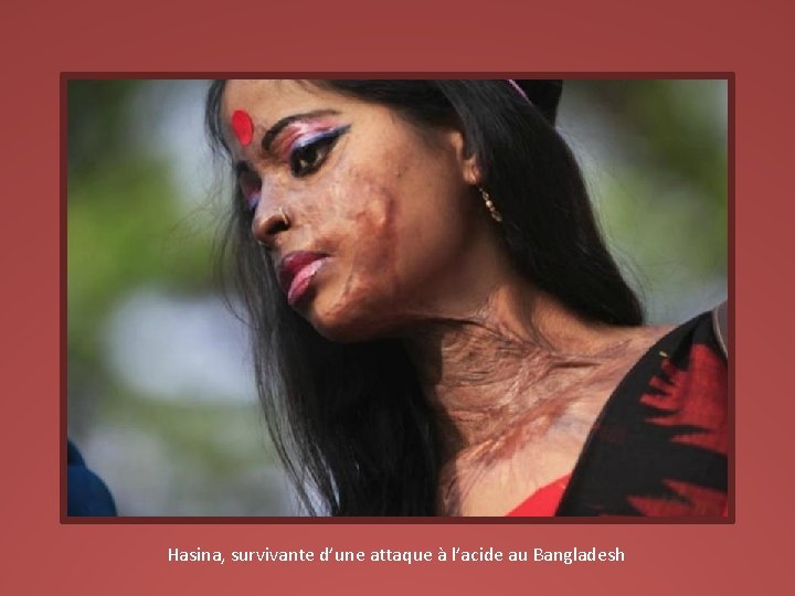 Hasina, survivante d’une attaque à l’acide au Bangladesh 