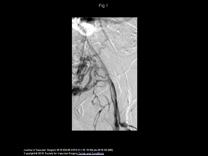 Fig 1 Journal of Vascular Surgery 2010 52243 -247 DOI: (10. 1016/j. jvs. 2010.