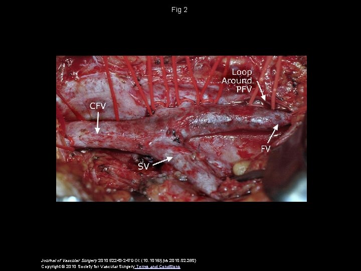 Fig 2 Journal of Vascular Surgery 2010 52243 -247 DOI: (10. 1016/j. jvs. 2010.