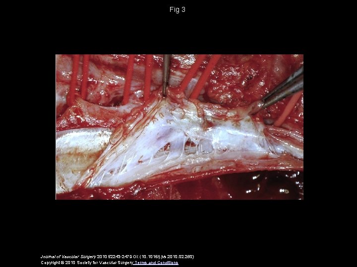 Fig 3 Journal of Vascular Surgery 2010 52243 -247 DOI: (10. 1016/j. jvs. 2010.