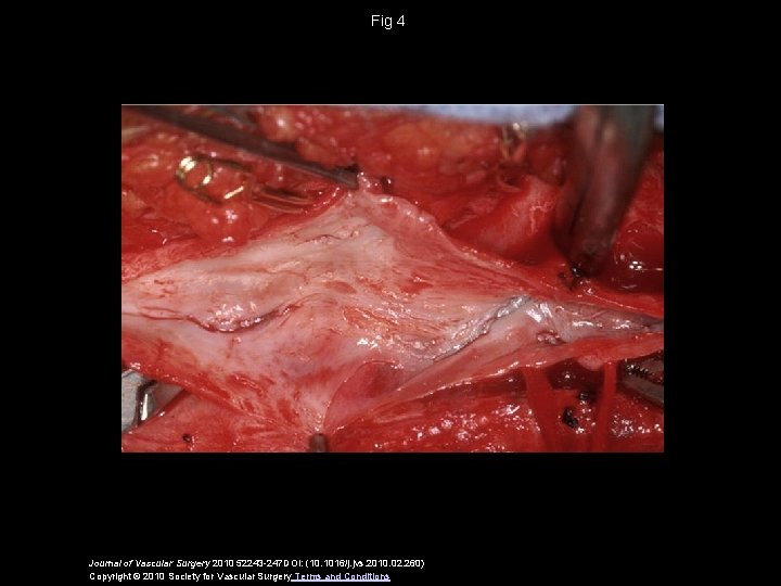 Fig 4 Journal of Vascular Surgery 2010 52243 -247 DOI: (10. 1016/j. jvs. 2010.