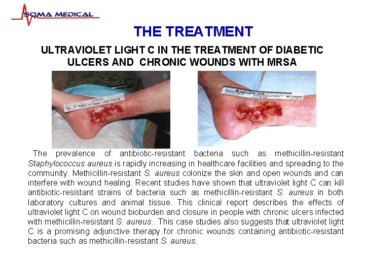 THE TREATMENT ULTRAVIOLET LIGHT C IN THE TREATMENT OF DIABETIC ULCERS AND CHRONIC WOUNDS
