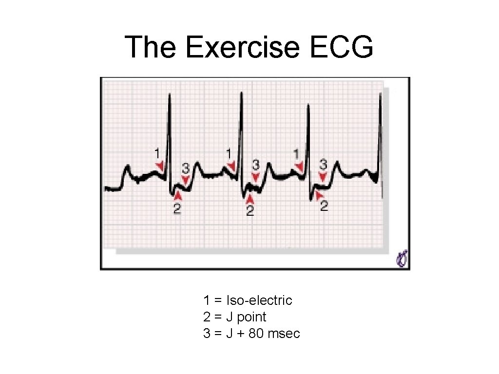 The Exercise ECG 1 = Iso-electric 2 = J point 3 = J +
