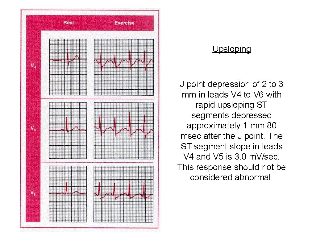 Upsloping J point depression of 2 to 3 mm in leads V 4 to