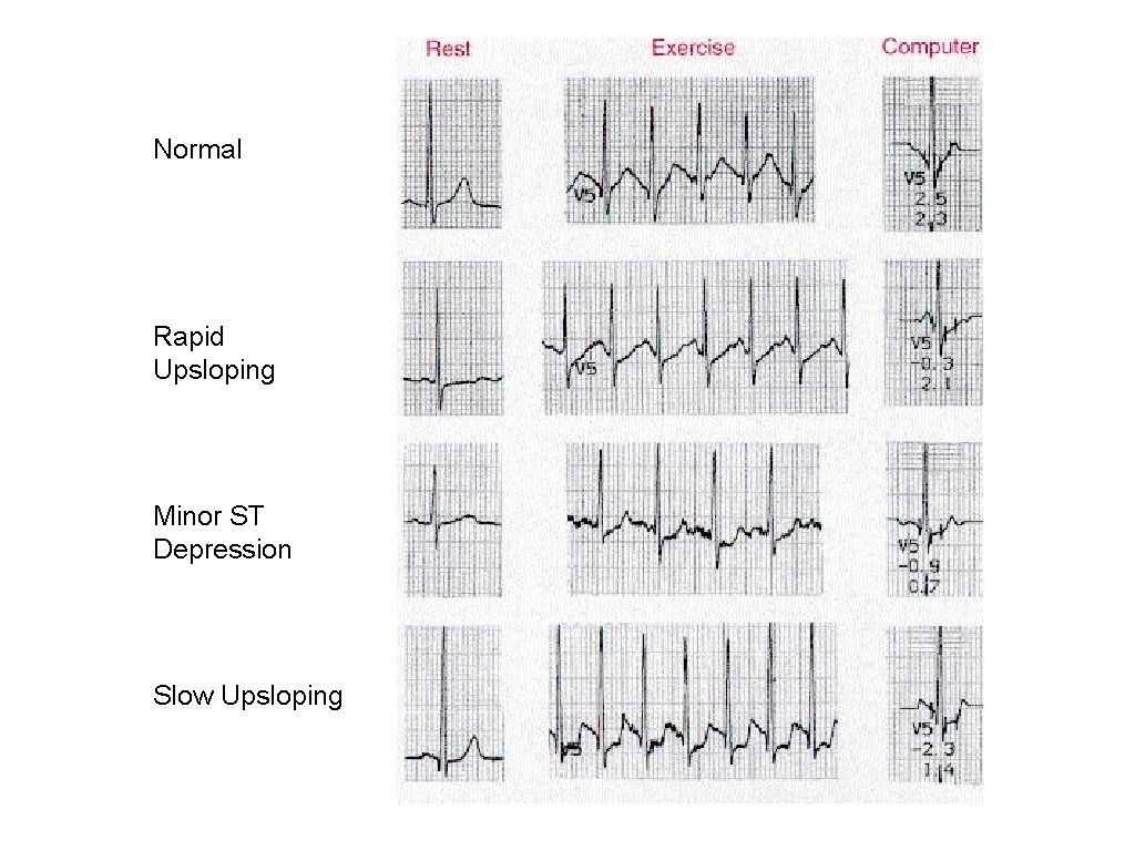 Normal Rapid Upsloping Minor ST Depression Slow Upsloping 