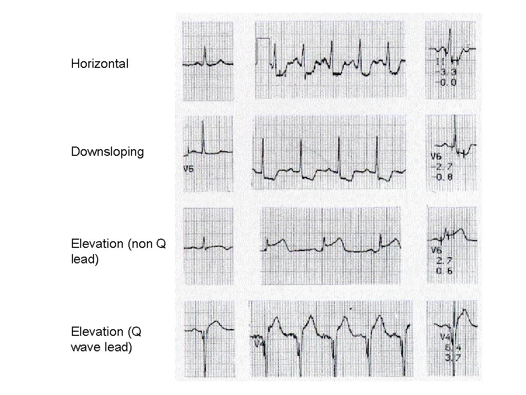 Horizontal Downsloping Elevation (non Q lead) Elevation (Q wave lead) 