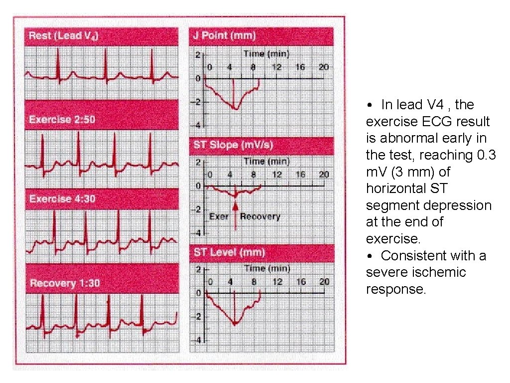  • In lead V 4 , the exercise ECG result is abnormal early