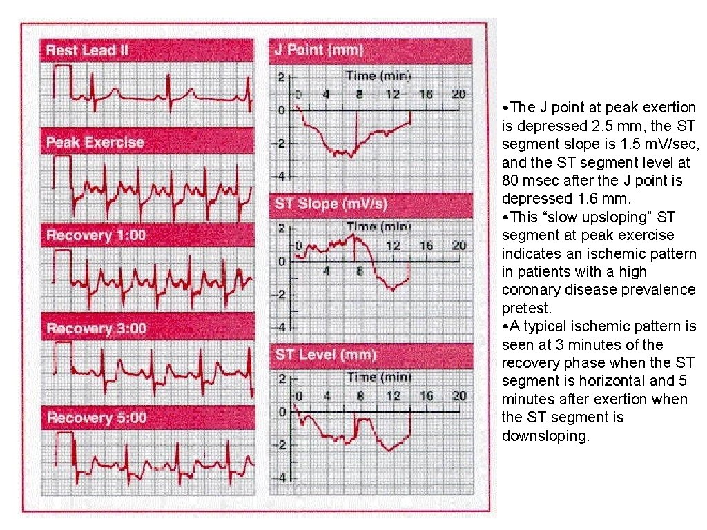  • The J point at peak exertion is depressed 2. 5 mm, the