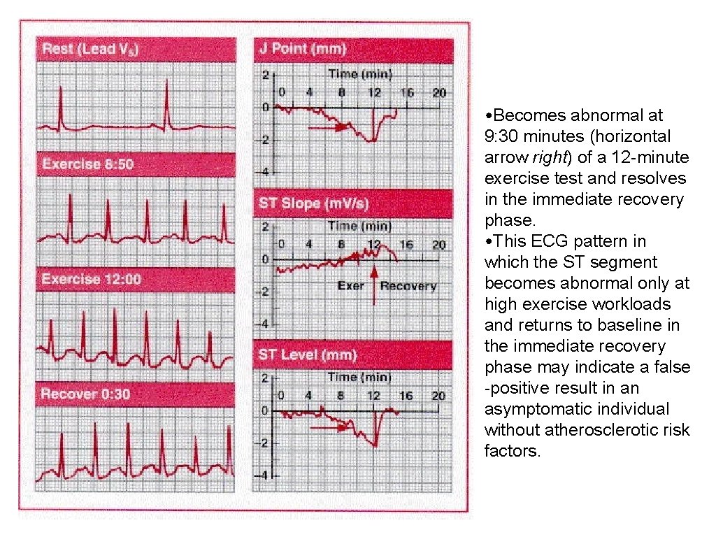  • Becomes abnormal at 9: 30 minutes (horizontal arrow right) of a 12