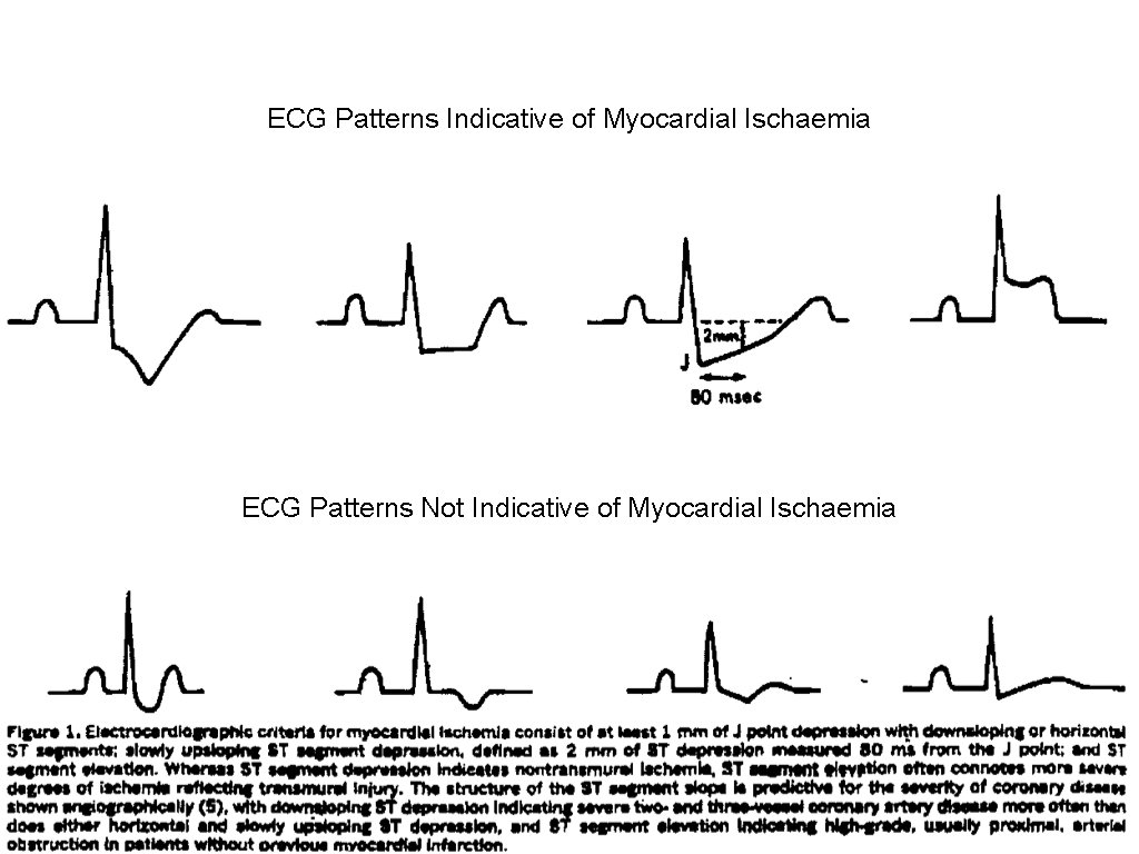 ECG Patterns Indicative of Myocardial Ischaemia ECG Patterns Not Indicative of Myocardial Ischaemia 