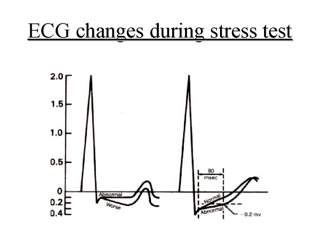 ECG changes during stress test 