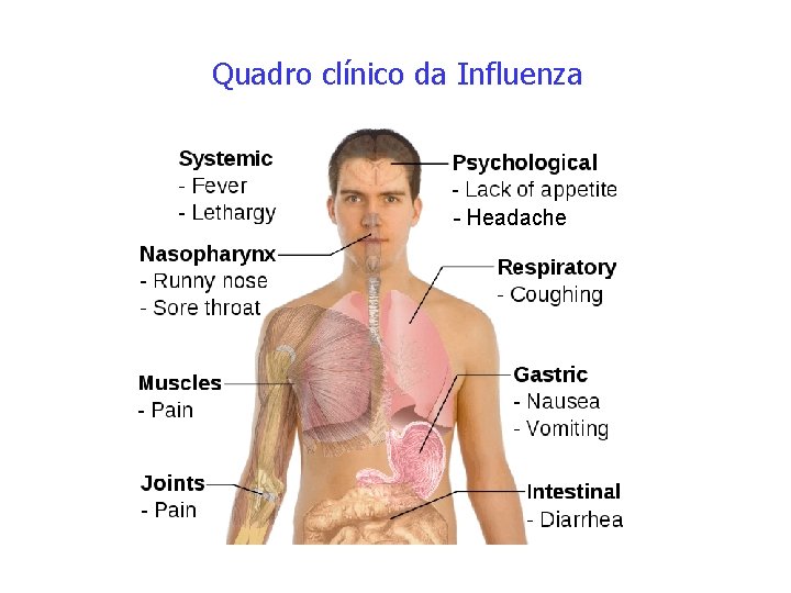 Quadro clínico da Influenza - Headache 