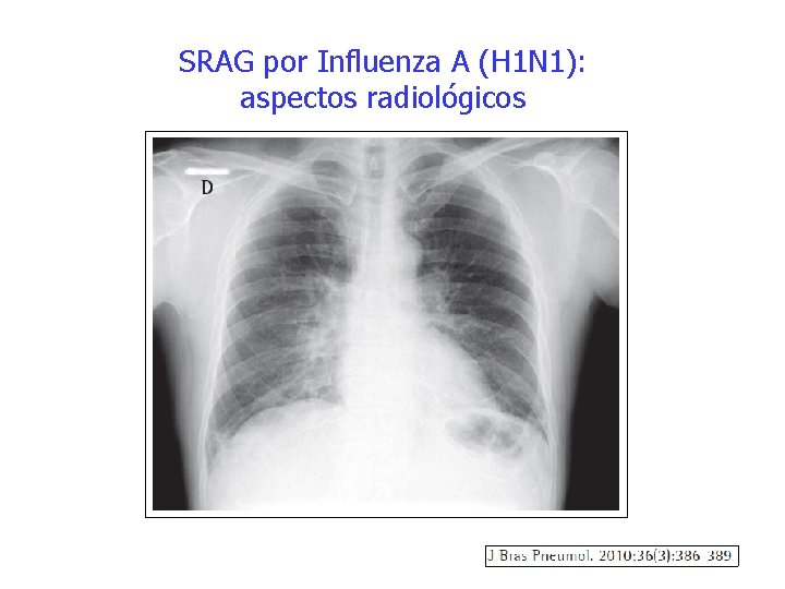 SRAG por Influenza A (H 1 N 1): aspectos radiológicos 