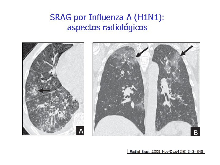 SRAG por Influenza A (H 1 N 1): aspectos radiológicos 