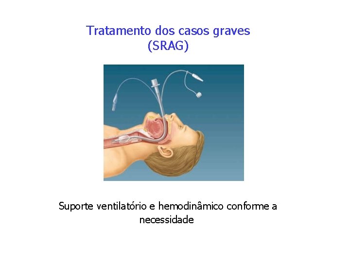 Tratamento dos casos graves (SRAG) Suporte ventilatório e hemodinâmico conforme a necessidade 