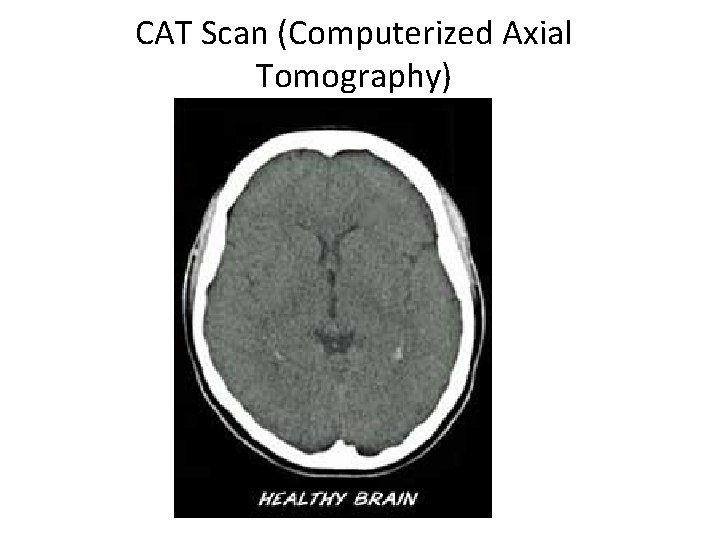 CAT Scan (Computerized Axial Tomography) 