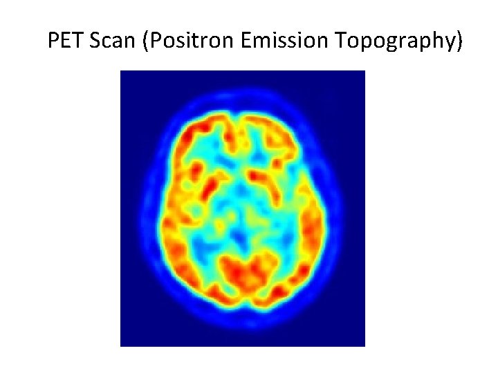 PET Scan (Positron Emission Topography) 