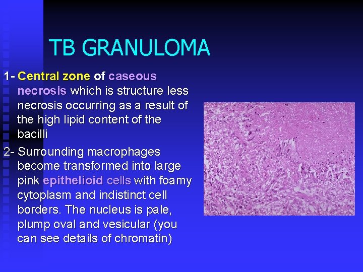 TB GRANULOMA 1 - Central zone of caseous necrosis which is structure less necrosis