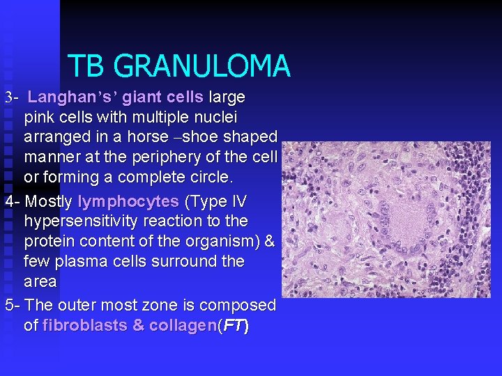 TB GRANULOMA 3 - Langhan’s’ giant cells large pink cells with multiple nuclei arranged