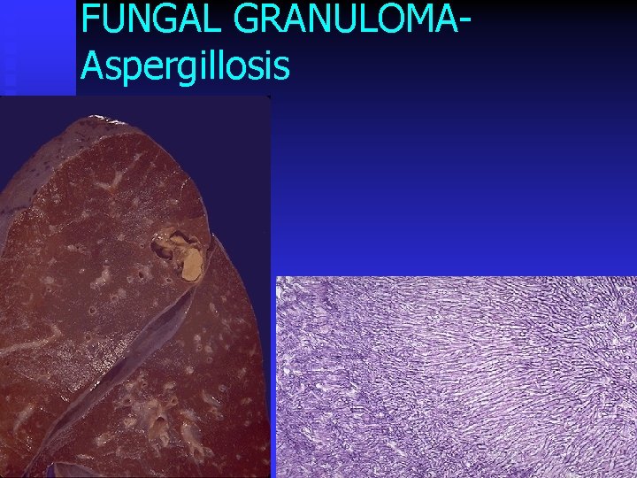 FUNGAL GRANULOMAAspergillosis 