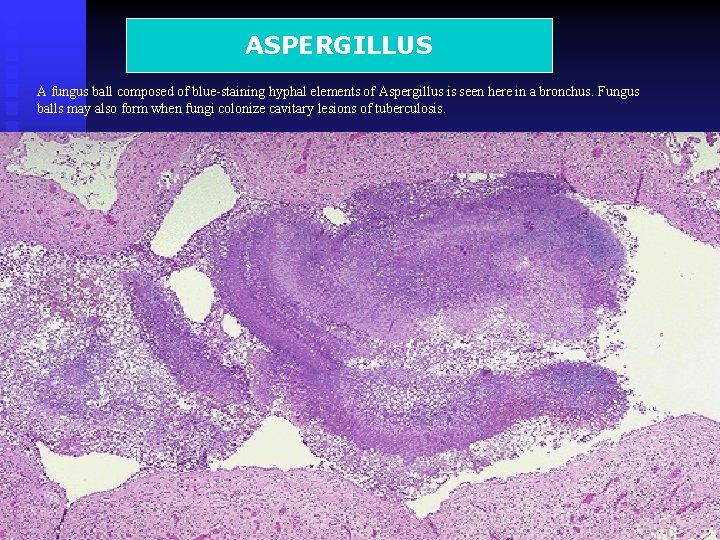 ASPERGILLUS A fungus ball composed of blue-staining hyphal elements of Aspergillus is seen here