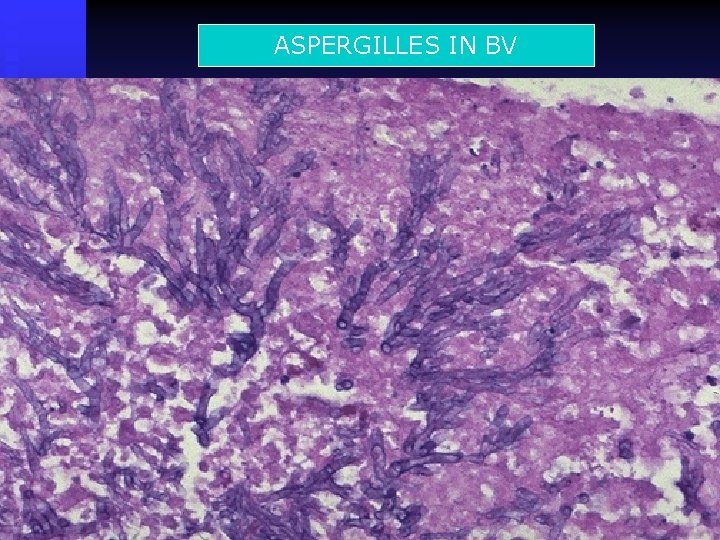 ASPERGILLES IN BV 