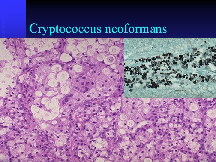 Cryptococcus neoformans 