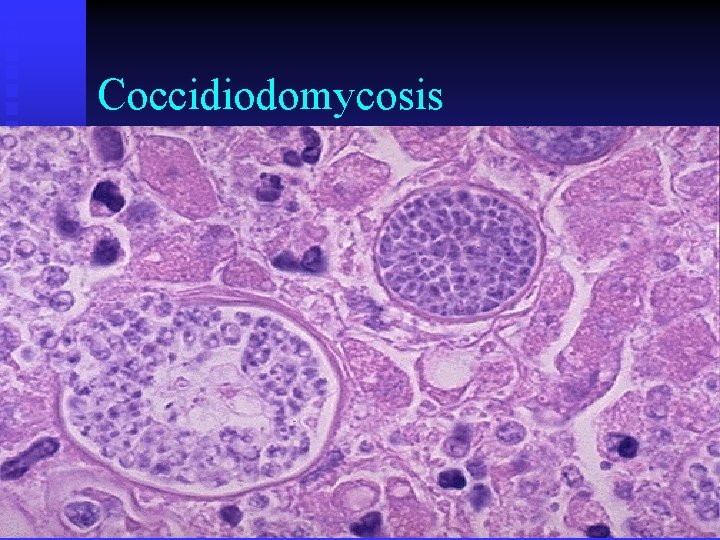 Coccidiodomycosis 