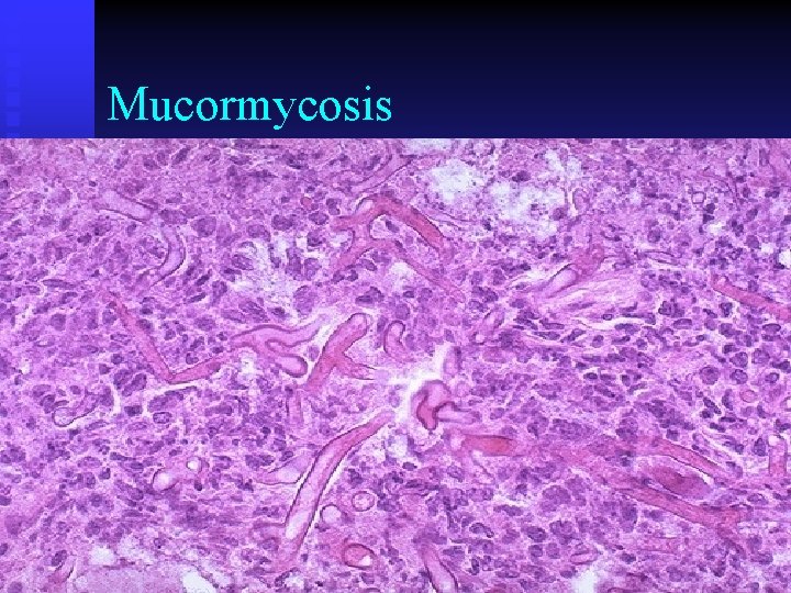 Mucormycosis 