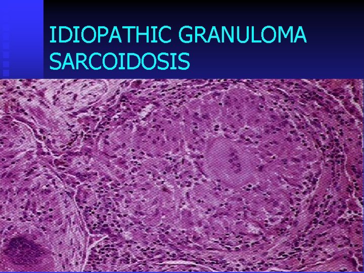 IDIOPATHIC GRANULOMA SARCOIDOSIS 