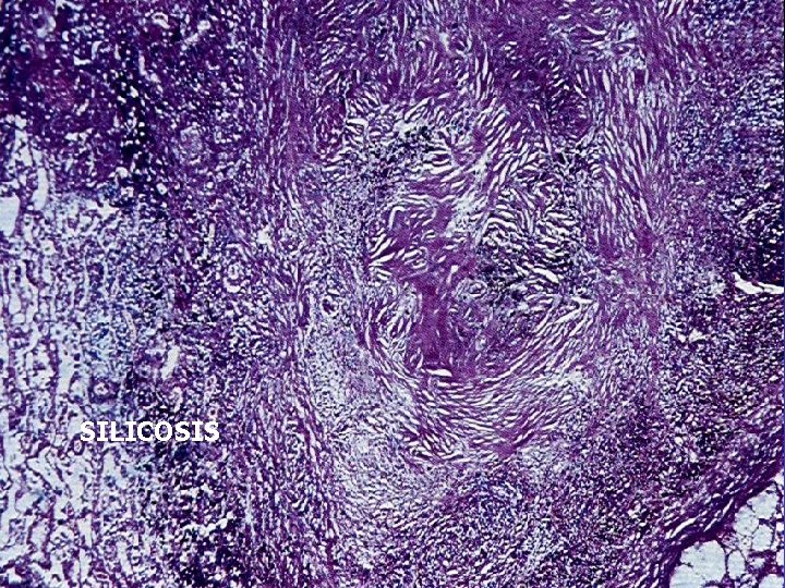 SILICOSIS 