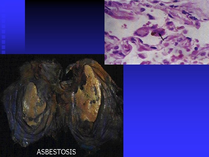ASBESTOSIS 