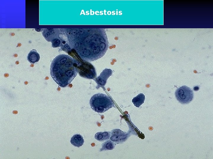Asbestosis 