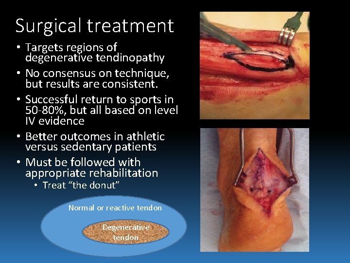 Surgical treatment • Targets regions of degenerative tendinopathy • No consensus on technique, but