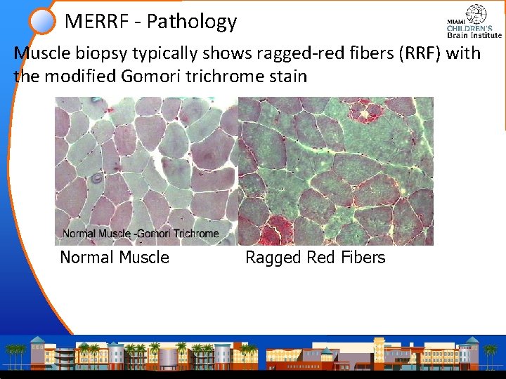 MERRF - Pathology Muscle biopsy typically shows ragged-red fibers (RRF) with the modified Gomori