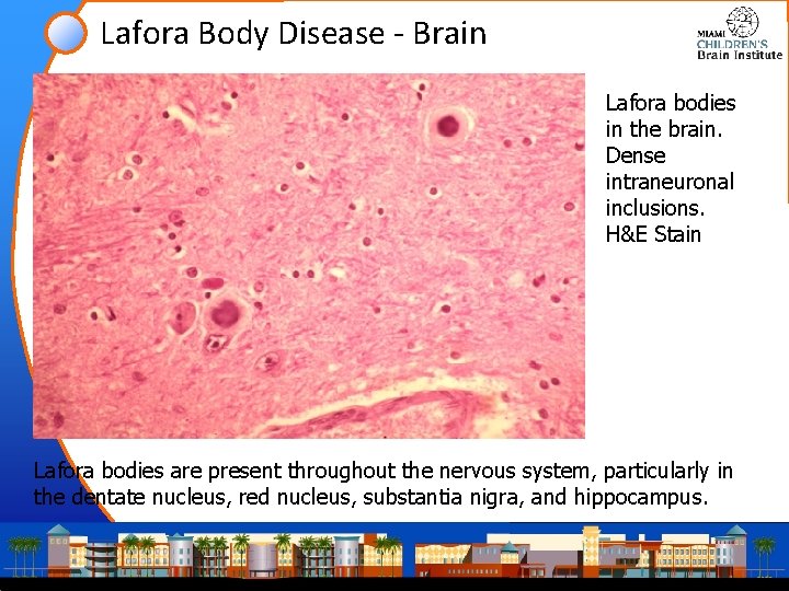 Lafora Body Disease - Brain Lafora bodies in the brain. Dense intraneuronal inclusions. H&E Lafora Body Disease - Brain Lafora bodies in the brain. Dense intraneuronal inclusions. H&E