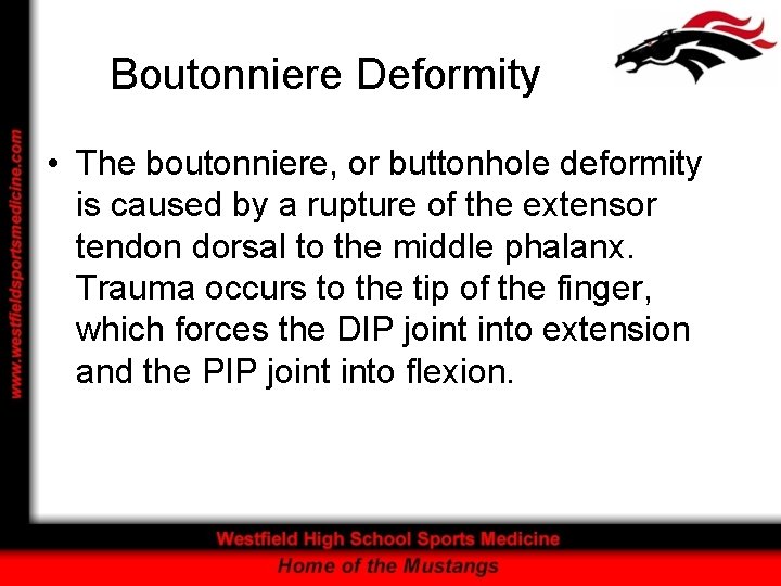 Boutonniere Deformity • The boutonniere, or buttonhole deformity is caused by a rupture of