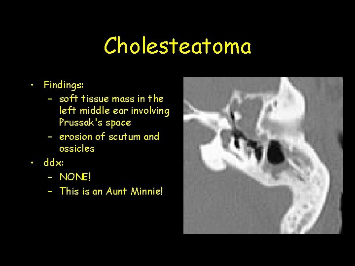 Cholesteatoma • Findings: – soft tissue mass in the left middle ear involving Prussak's Cholesteatoma • Findings: – soft tissue mass in the left middle ear involving Prussak's