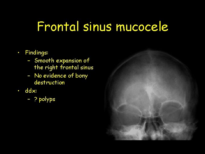 Frontal sinus mucocele • Findings: – Smooth expansion of the right frontal sinus – Frontal sinus mucocele • Findings: – Smooth expansion of the right frontal sinus –