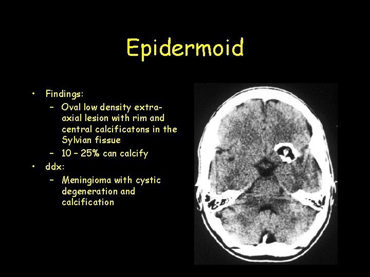 Epidermoid • • Findings: – Oval low density extraaxial lesion with rim and central Epidermoid • • Findings: – Oval low density extraaxial lesion with rim and central
