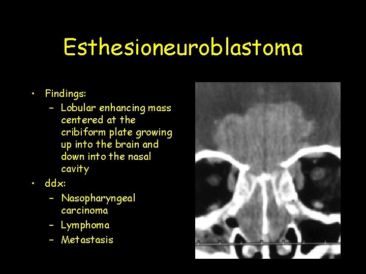 Esthesioneuroblastoma • Findings: – Lobular enhancing mass centered at the cribiform plate growing up Esthesioneuroblastoma • Findings: – Lobular enhancing mass centered at the cribiform plate growing up