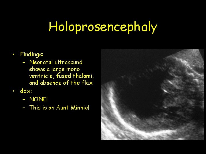 Holoprosencephaly • Findings: – Neonatal ultrasound shows a large mono ventricle, fused thalami, and Holoprosencephaly • Findings: – Neonatal ultrasound shows a large mono ventricle, fused thalami, and